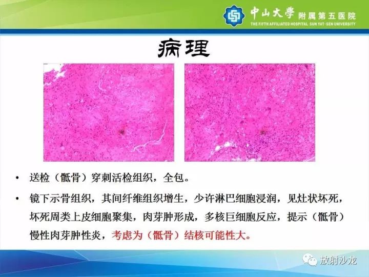 【病例】骶骨结核1例X线CT及MR