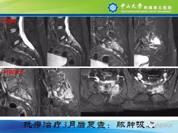 【病例】骶骨结核1例X线CT及MR