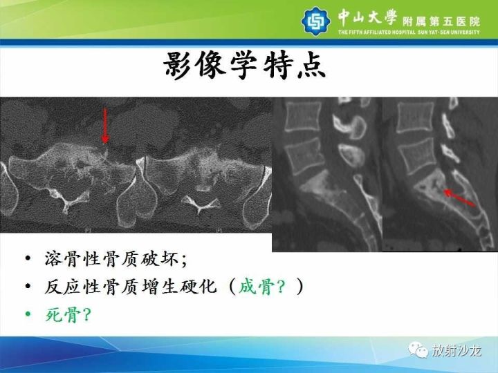 【病例】骶骨结核1例X线CT及MR