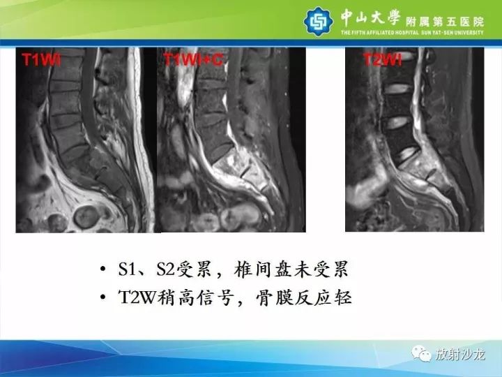 【病例】骶骨结核1例X线CT及MR