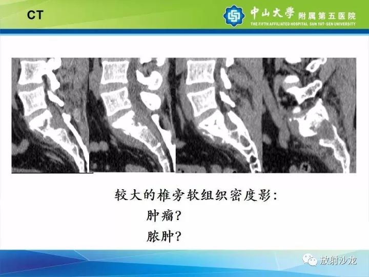【病例】骶骨结核1例X线CT及MR