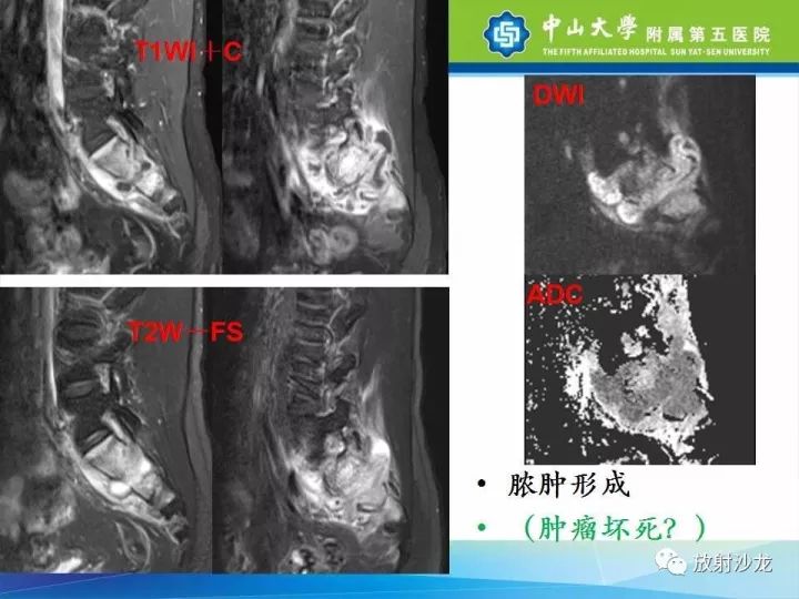 【病例】骶骨结核1例X线CT及MR