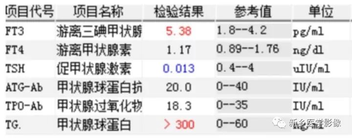 【病例】结节性甲状腺肿囊性变1例CT影像表现 【病例】结节性甲状腺肿囊性变1例CT影像表现