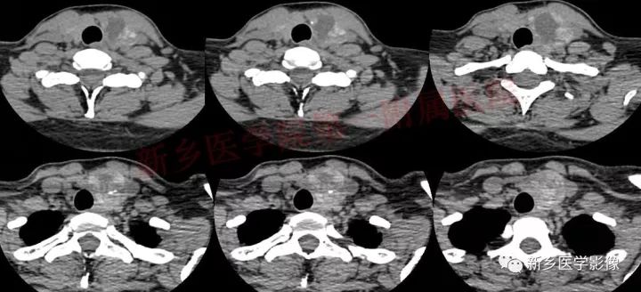 【病例】结节性甲状腺肿囊性变1例CT影像表现 【病例】结节性甲状腺肿囊性变1例CT影像表现