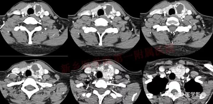 【病例】结节性甲状腺肿囊性变1例CT影像表现 【病例】结节性甲状腺肿囊性变1例CT影像表现
