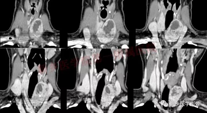 【病例】结节性甲状腺肿囊性变1例CT影像表现 【病例】结节性甲状腺肿囊性变1例CT影像表现