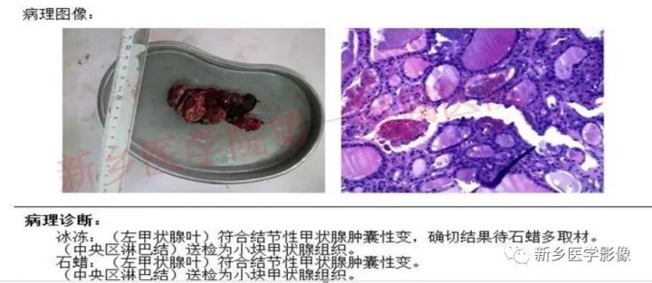 【病例】结节性甲状腺肿囊性变1例CT影像表现 【病例】结节性甲状腺肿囊性变1例CT影像表现