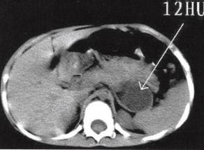 【病例】腹膜后肠源性囊肿1例CT