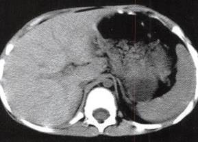 【病例】腹膜后肠源性囊肿1例CT 【病例】腹膜后肠源性囊肿1例CT
