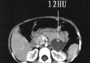 【病例】腹膜后肠源性囊肿1例CT 【病例】腹膜后肠源性囊肿1例CT