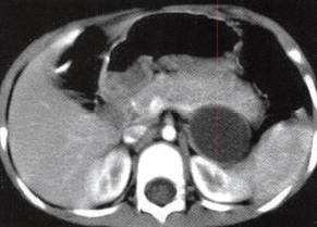 【病例】腹膜后肠源性囊肿1例CT 【病例】腹膜后肠源性囊肿1例CT
