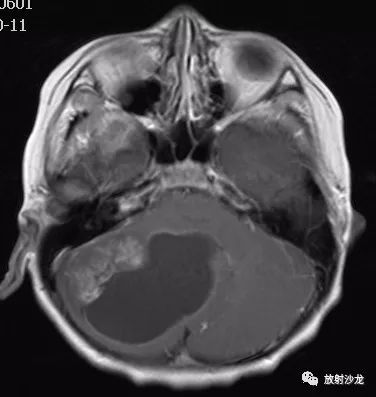【病例】小脑毛细胞型星形细胞瘤1例MR 【病例】小脑毛细胞型星形细胞瘤1例MR