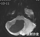 【病例】小脑毛细胞型星形细胞瘤1例MR 【病例】小脑毛细胞型星形细胞瘤1例MR