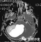 【病例】小脑毛细胞型星形细胞瘤1例MR 【病例】小脑毛细胞型星形细胞瘤1例MR
