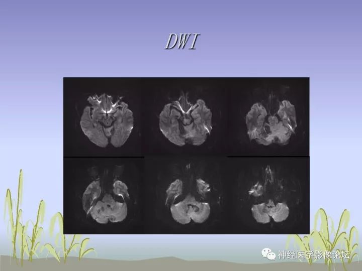 【病例】中枢神经系统Rosai-Dorfman病RDD一例影像讨论 【病例】中枢神经系统Rosai-Dorfman病RDD一例影像讨论