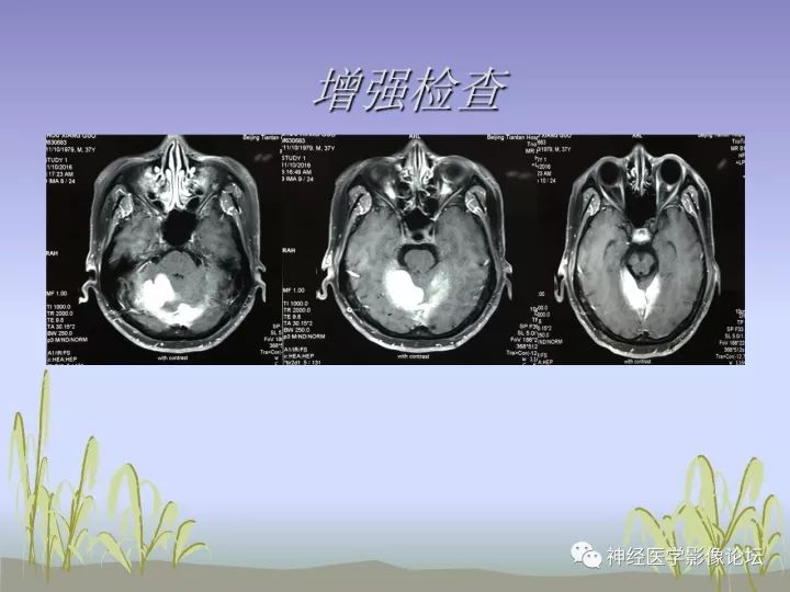 【病例】中枢神经系统Rosai-Dorfman病RDD一例影像讨论 【病例】中枢神经系统Rosai-Dorfman病RDD一例影像讨论
