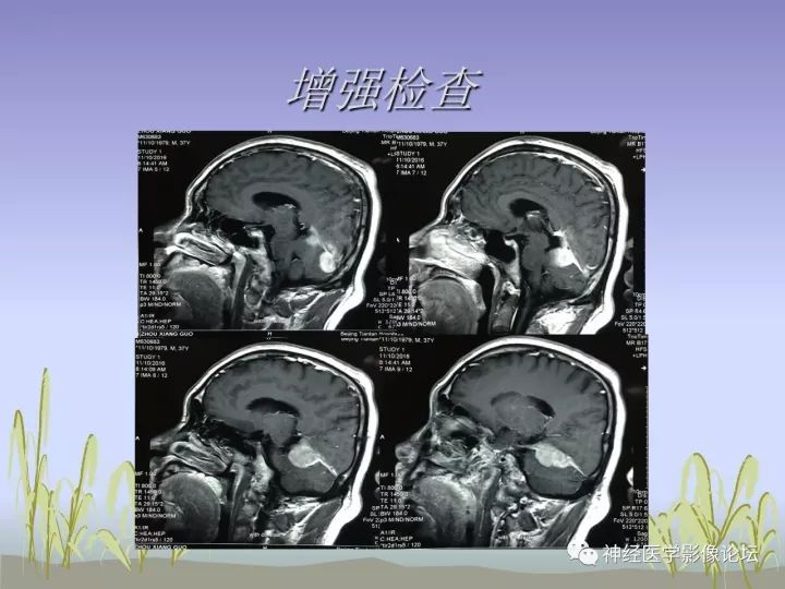 【病例】中枢神经系统Rosai-Dorfman病RDD一例影像讨论 【病例】中枢神经系统Rosai-Dorfman病RDD一例影像讨论