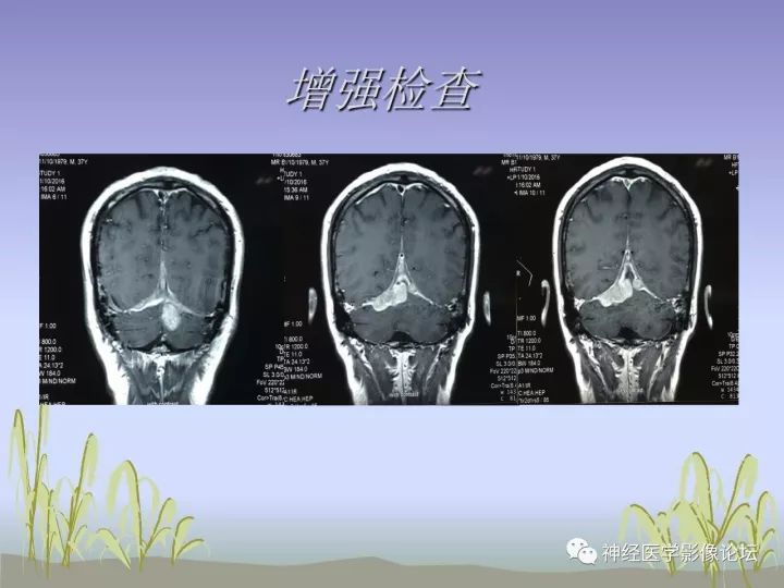 【病例】中枢神经系统Rosai-Dorfman病RDD一例影像讨论 【病例】中枢神经系统Rosai-Dorfman病RDD一例影像讨论