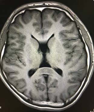【病例】可逆性胼胝体压部综合征1例MR影像表现 【病例】可逆性胼胝体压部综合征1例MR影像表现