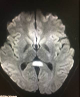【病例】可逆性胼胝体压部综合征1例MR影像表现 【病例】可逆性胼胝体压部综合征1例MR影像表现