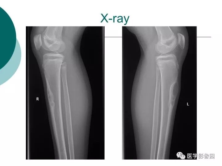 【病例】胫骨骨纤维异常增殖症1例CT及MR