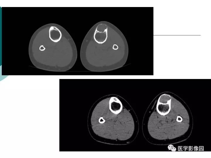 【病例】胫骨骨纤维异常增殖症1例CT及MR