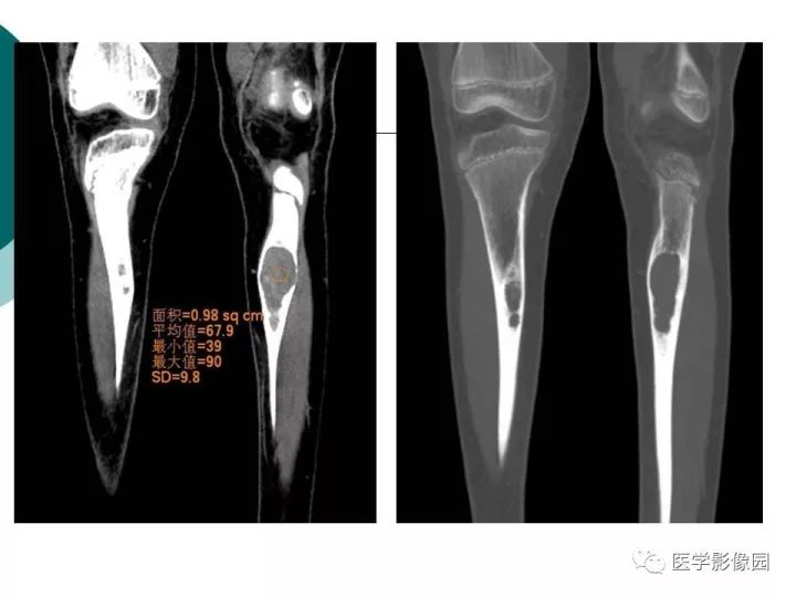 【病例】胫骨骨纤维异常增殖症1例CT及MR