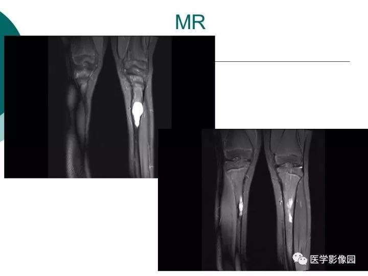 【病例】胫骨骨纤维异常增殖症1例CT及MR