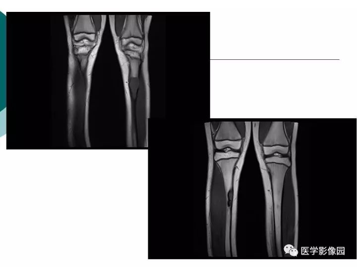 【病例】胫骨骨纤维异常增殖症1例CT及MR