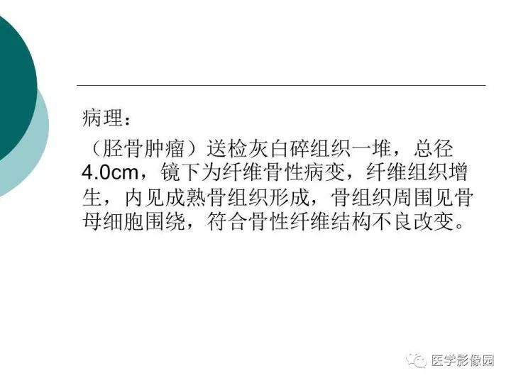 【病例】胫骨骨纤维异常增殖症1例CT及MR