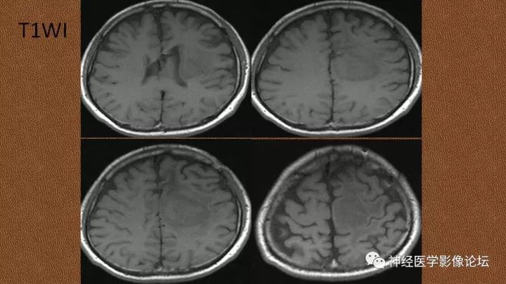 【病例】脑实质淀粉瘤1例MR影像表现