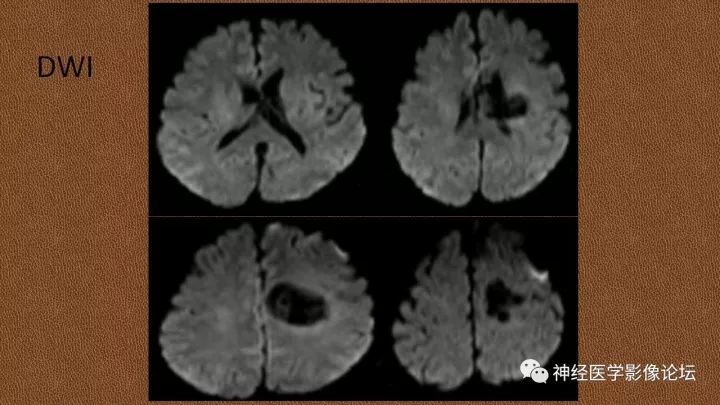 【病例】脑实质淀粉瘤1例MR影像表现