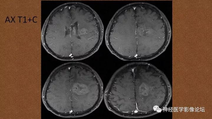 【病例】脑实质淀粉瘤1例MR影像表现