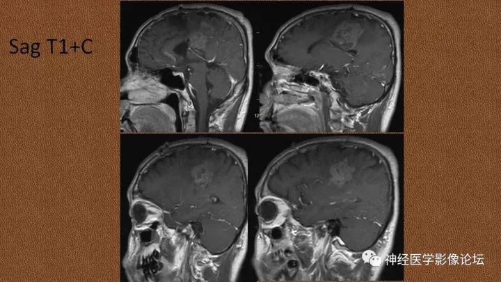 【病例】脑实质淀粉瘤1例MR影像表现