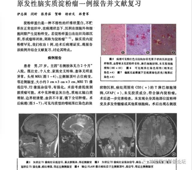 【病例】脑实质淀粉瘤1例MR影像表现
