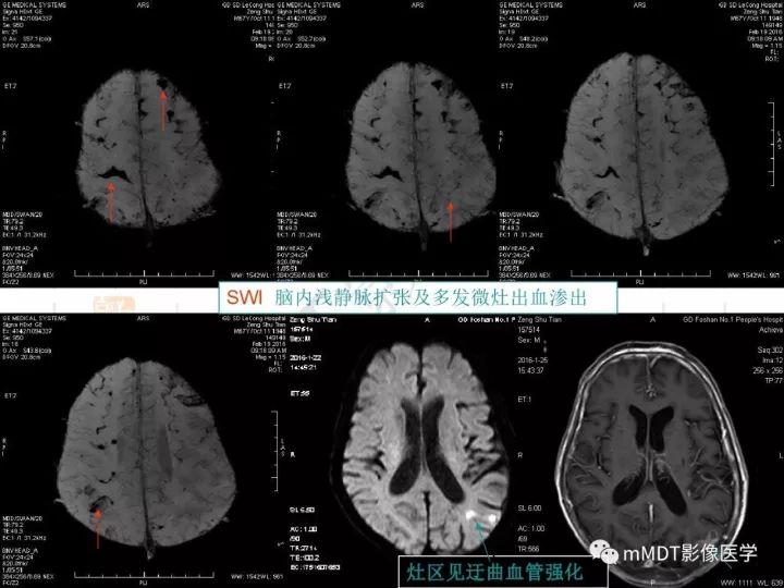 【PPT】中枢神经系统血管炎(CNSV)的表现与特征