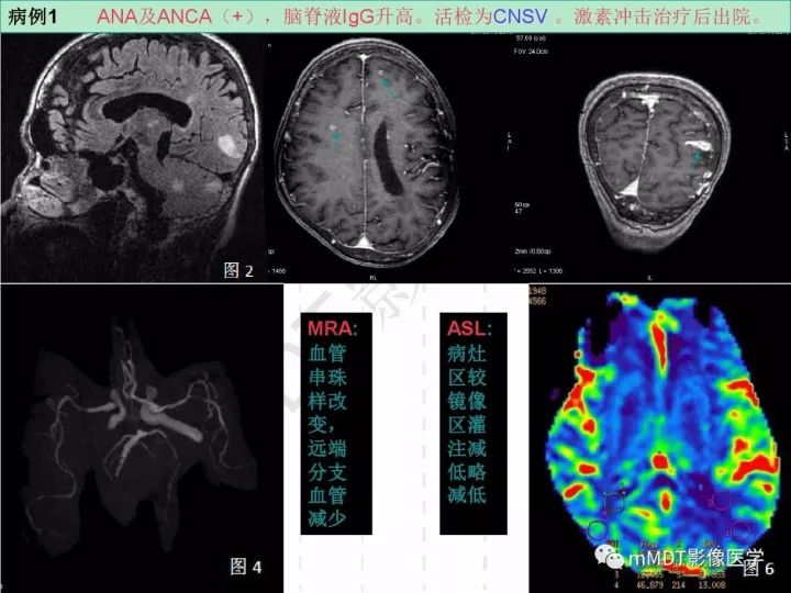【PPT】中枢神经系统血管炎(CNSV)的表现与特征