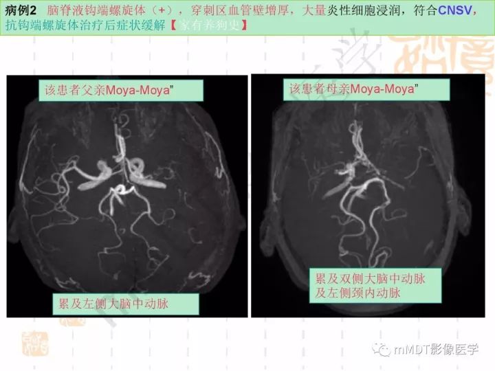 【PPT】中枢神经系统血管炎(CNSV)的表现与特征