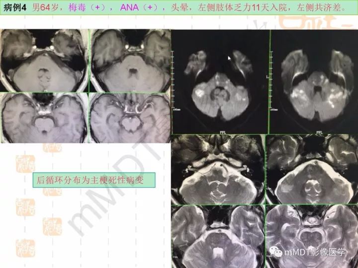 【PPT】中枢神经系统血管炎(CNSV)的表现与特征