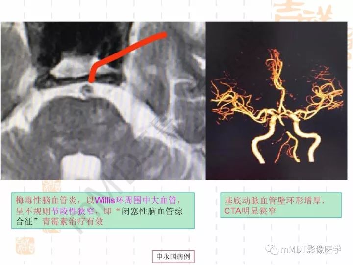 【PPT】中枢神经系统血管炎(CNSV)的表现与特征