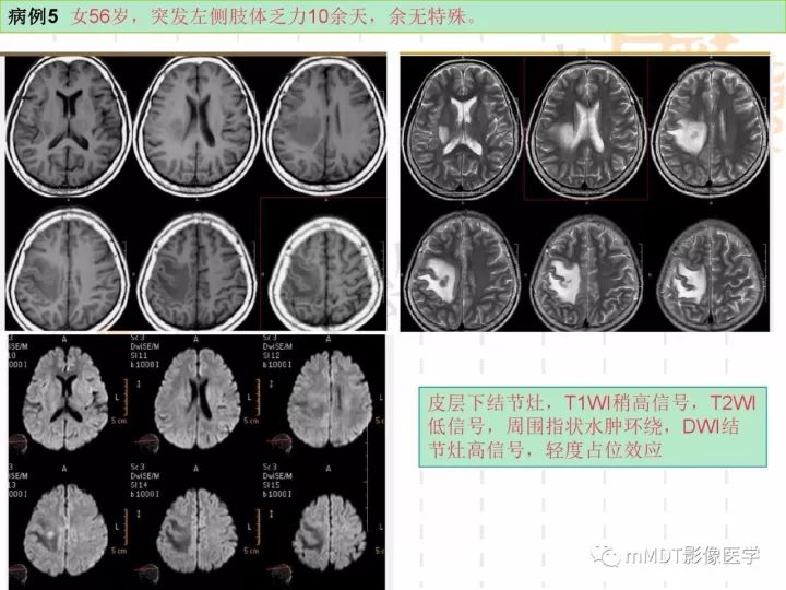 【PPT】中枢神经系统血管炎(CNSV)的表现与特征