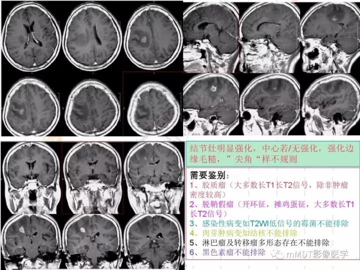 【PPT】中枢神经系统血管炎(CNSV)的表现与特征