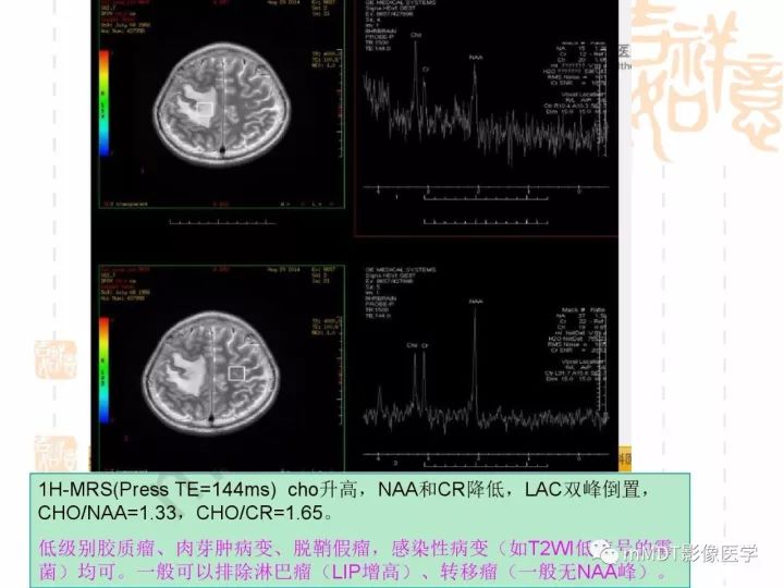 【PPT】中枢神经系统血管炎(CNSV)的表现与特征