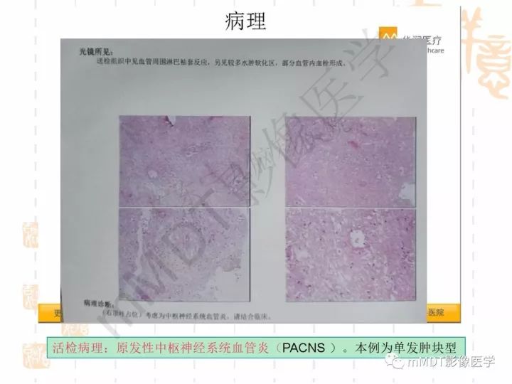 【PPT】中枢神经系统血管炎(CNSV)的表现与特征