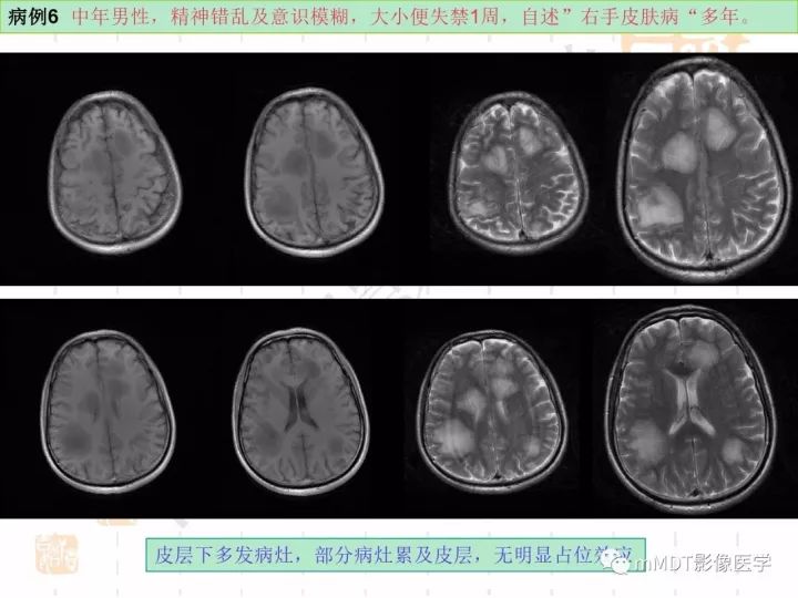 【PPT】中枢神经系统血管炎(CNSV)的表现与特征