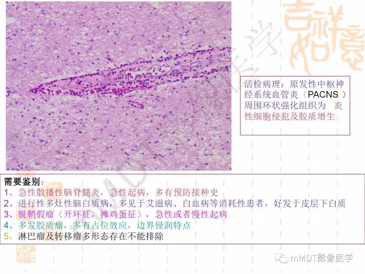【PPT】中枢神经系统血管炎(CNSV)的表现与特征