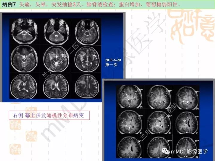 【PPT】中枢神经系统血管炎(CNSV)的表现与特征