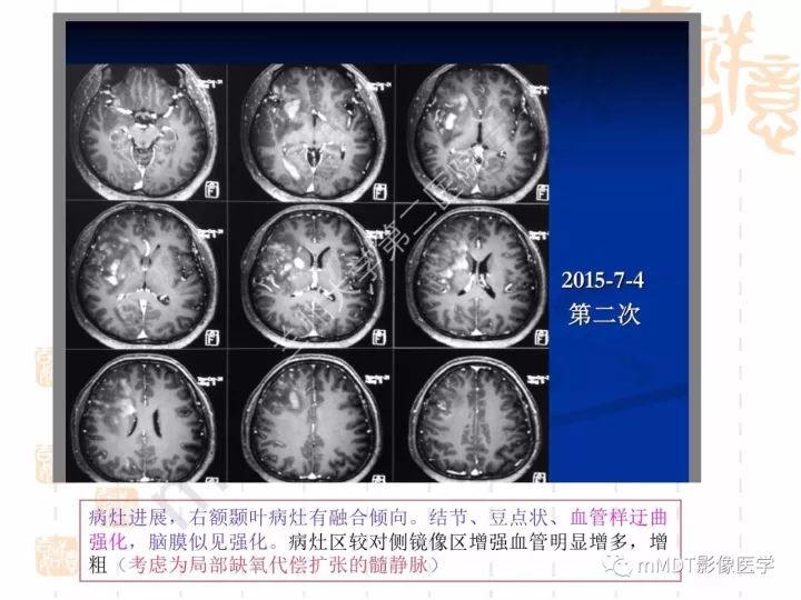 【PPT】中枢神经系统血管炎(CNSV)的表现与特征
