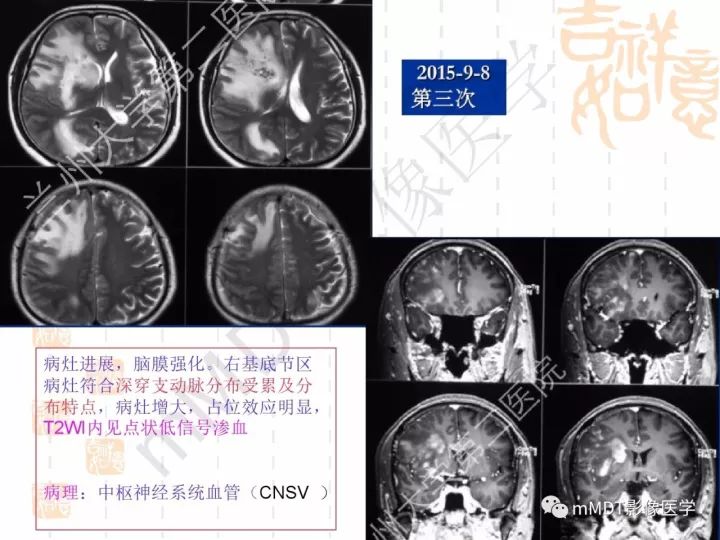【PPT】中枢神经系统血管炎(CNSV)的表现与特征