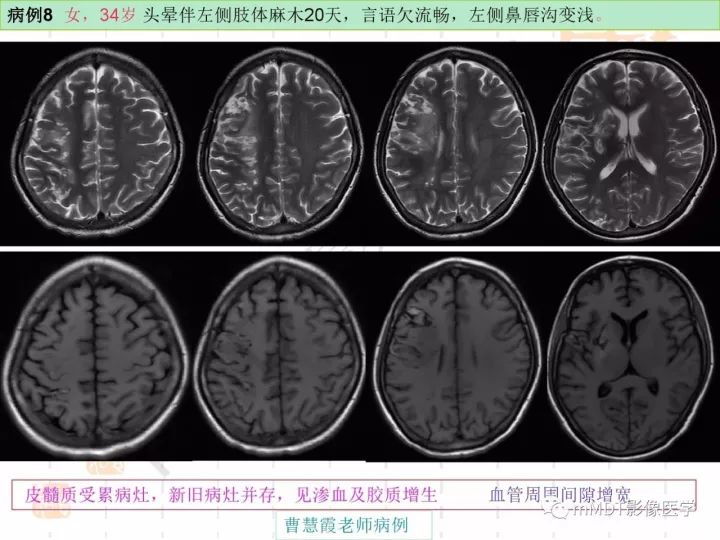 【PPT】中枢神经系统血管炎(CNSV)的表现与特征